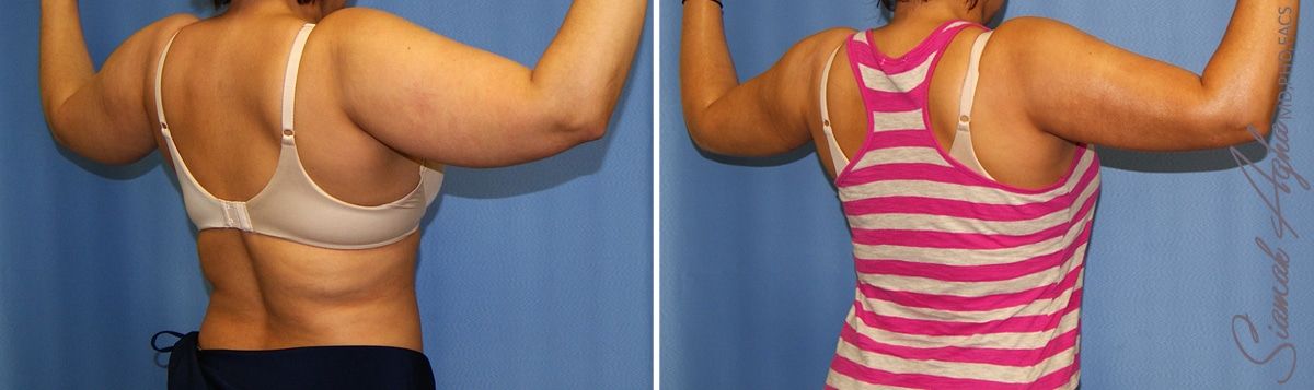 Arm Lift Before & After