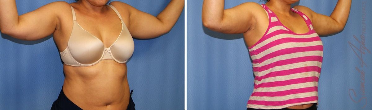 Arm Lift Before & After