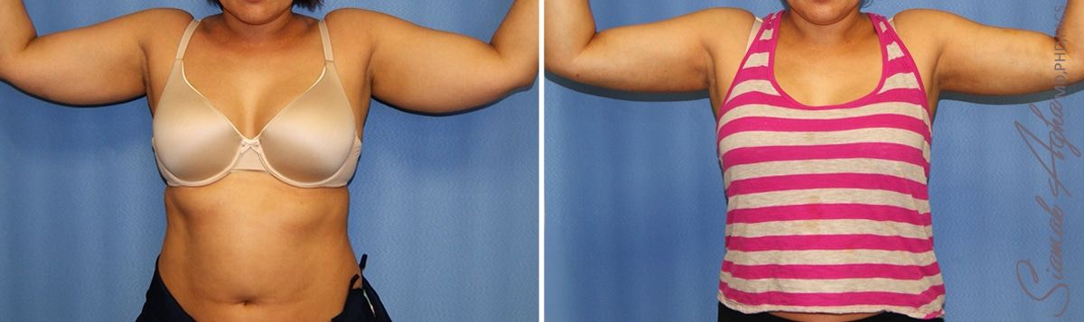 Arm Lift Before & After