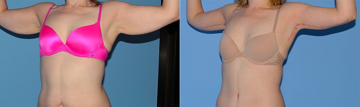 Arm Lift Before & After