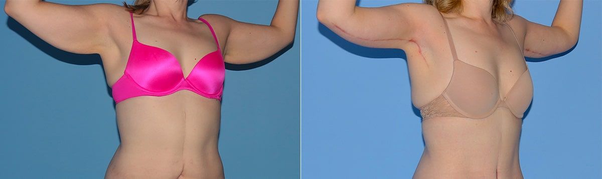 Arm Lift Before & After