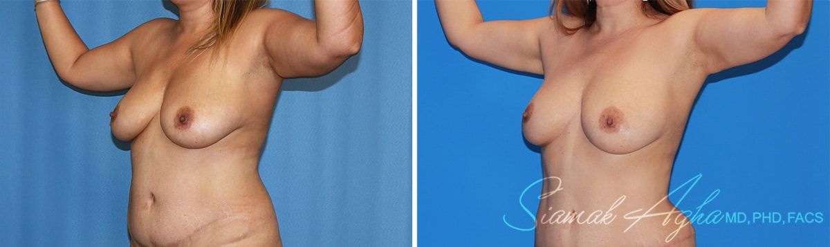 Arm Lift Before & After