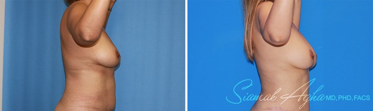 Arm Lift Before & After