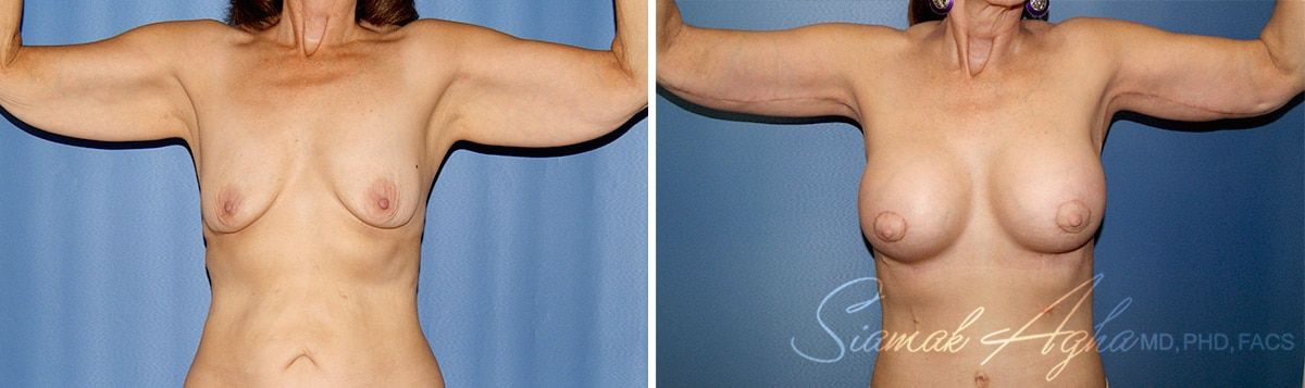 Arm Lift Before & After