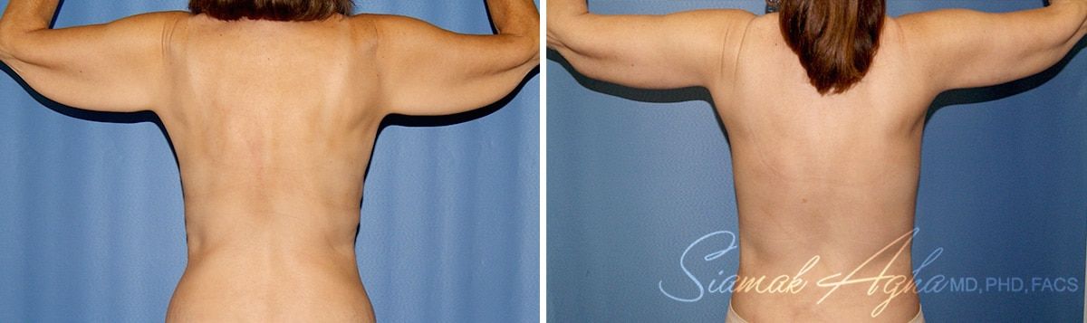 Arm Lift Before & After