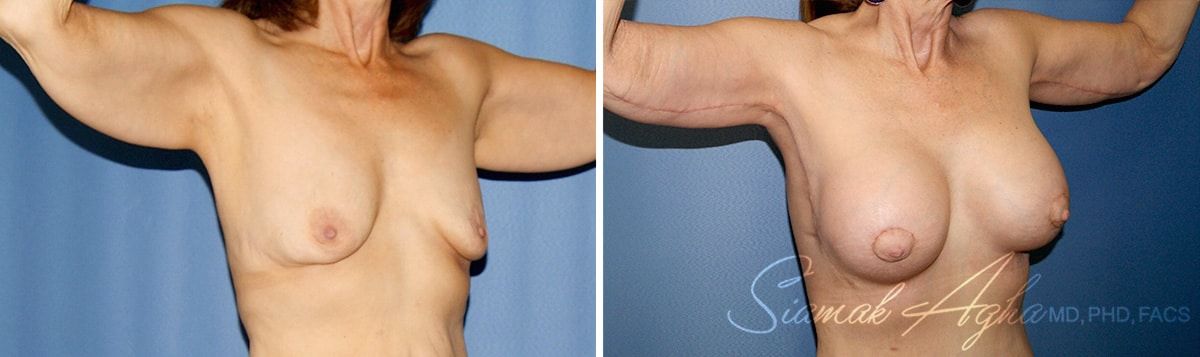 Arm Lift Before & After