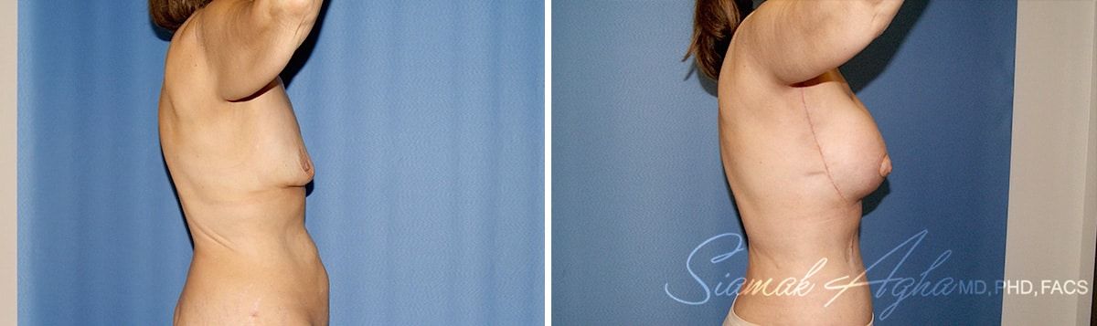 Arm Lift Before & After