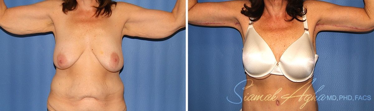 Arm Lift Before & After