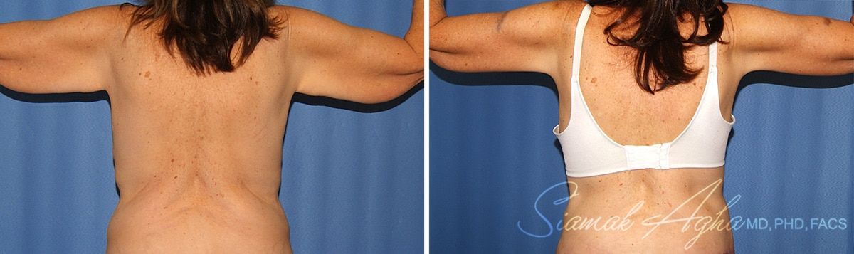 Arm Lift Before & After