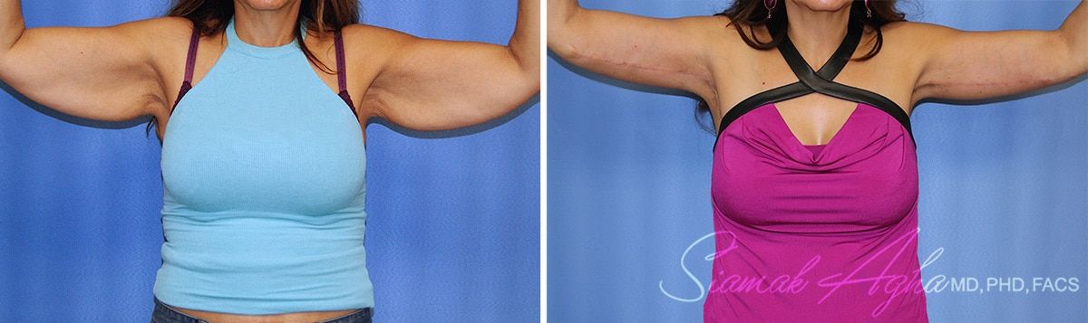 Arm Lift Before & After