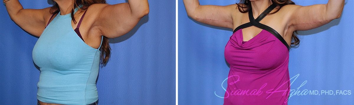 Arm Lift Before & After