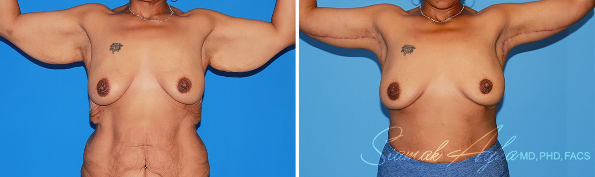 Arm Lift Before & After