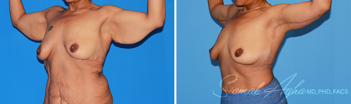 Arm Lift Before & After