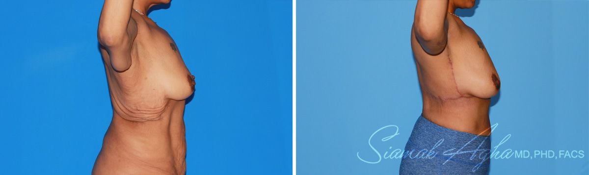 Arm Lift Before & After