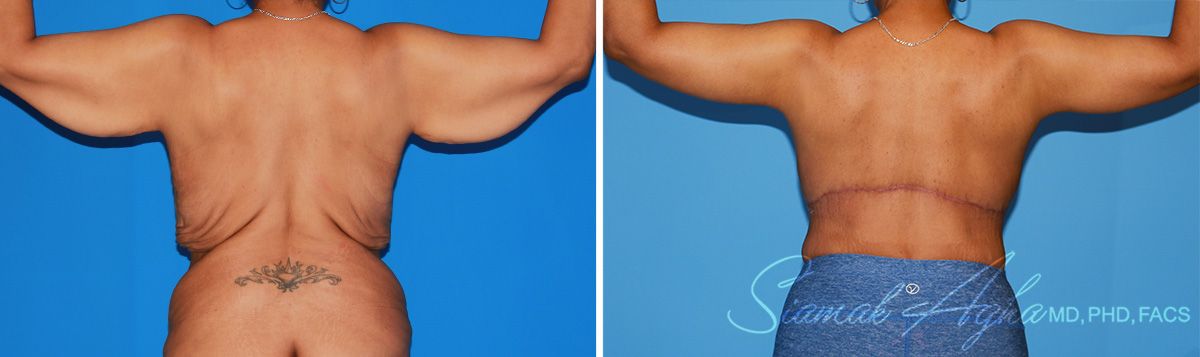 Arm Lift Before & After