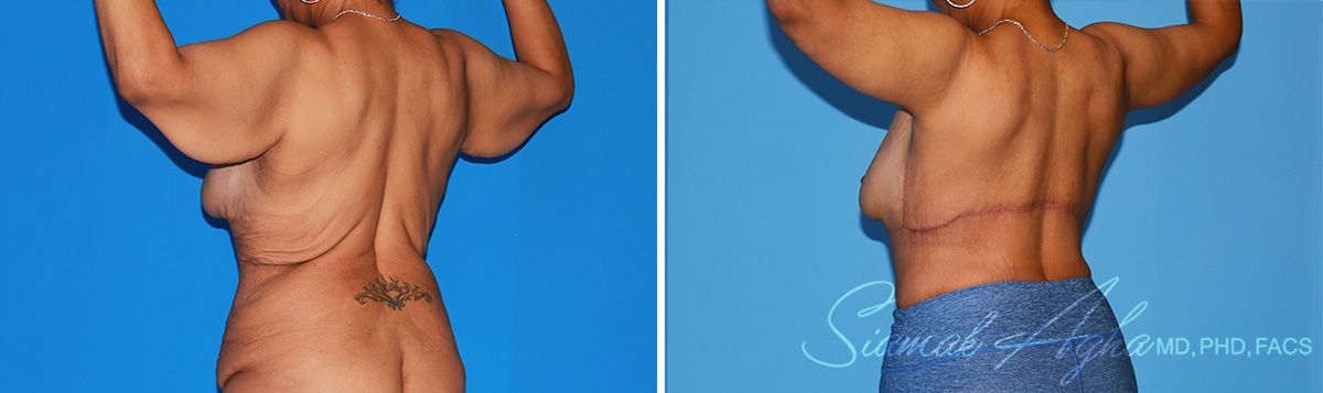 Arm Lift Before & After