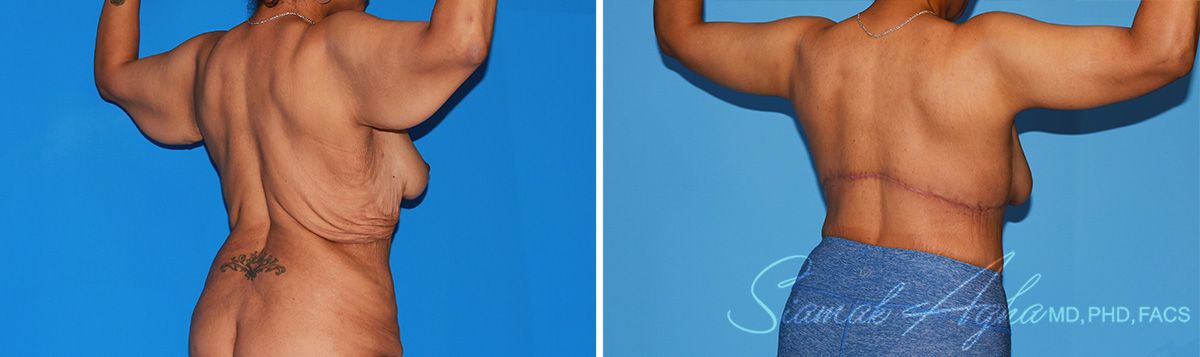 Arm Lift Before & After