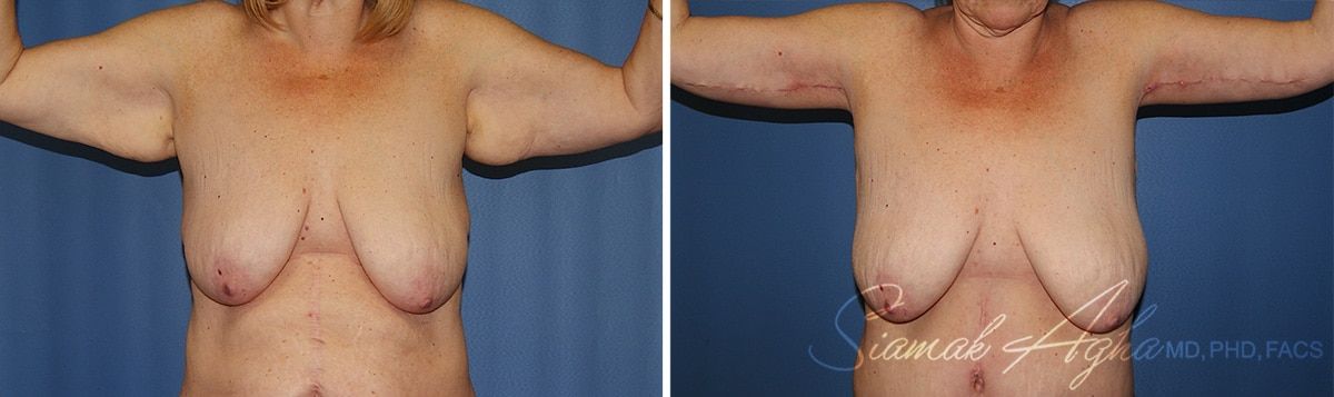 Arm Lift Before & After