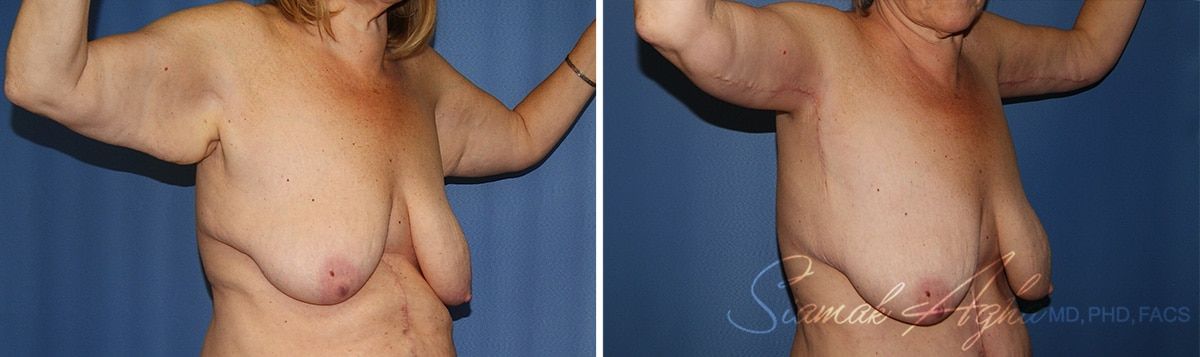 Arm Lift Before & After