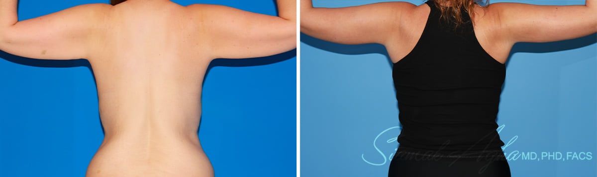 Arm Lift Before & After