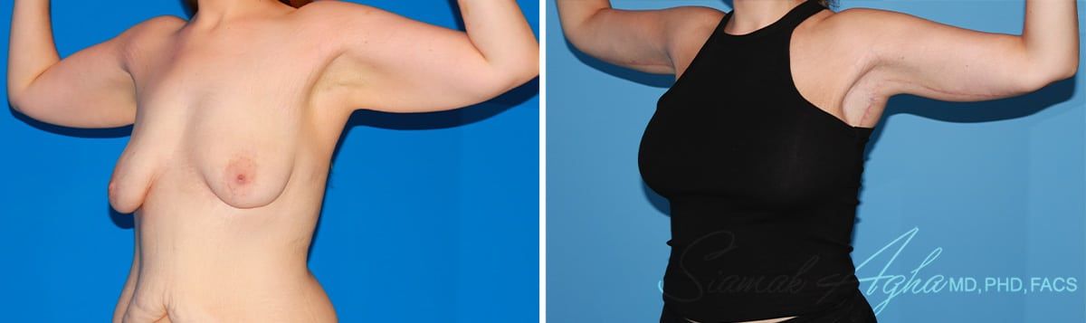 Arm Lift Before & After