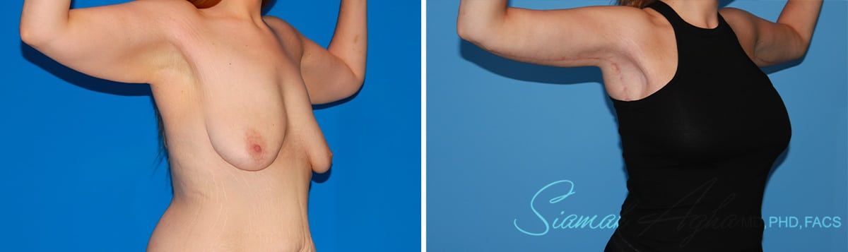 Arm Lift Before & After