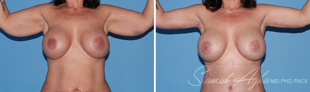 Arm Lift Before & After