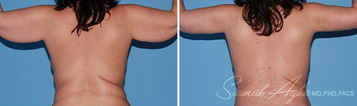 Arm Lift Before & After