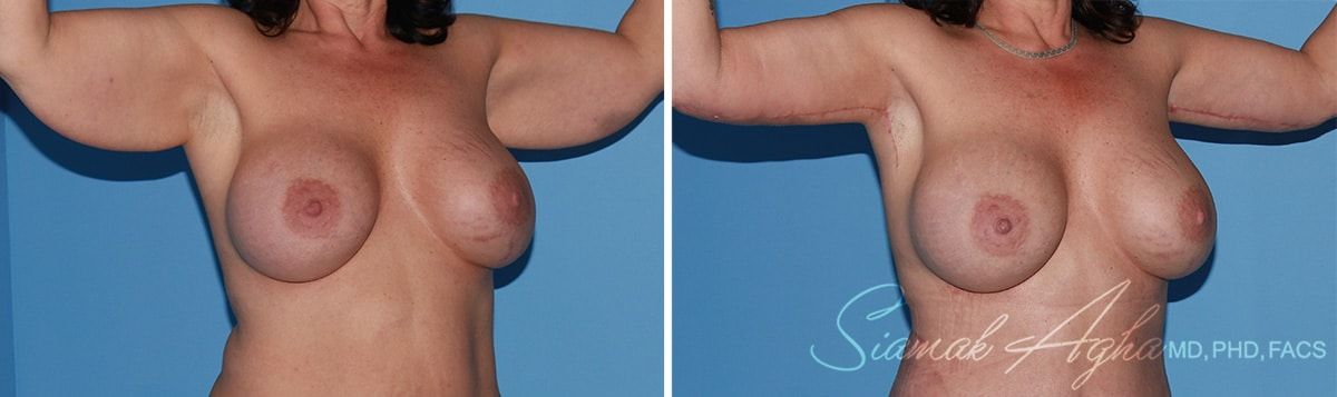 Arm Lift Before & After