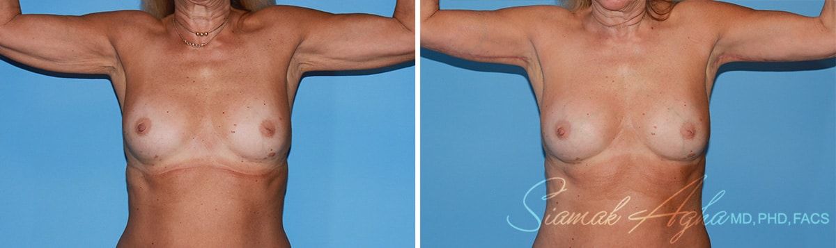 Arm Lift Before & After