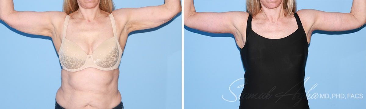 Arm Lift Before & After