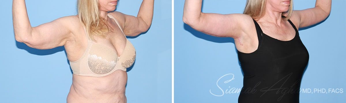 Arm Lift Before & After