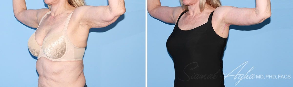 Arm Lift Before & After