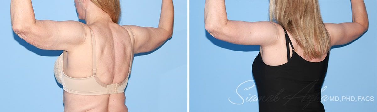 Arm Lift Before & After