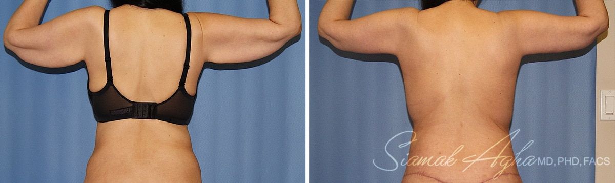 Arm Lift Before & After