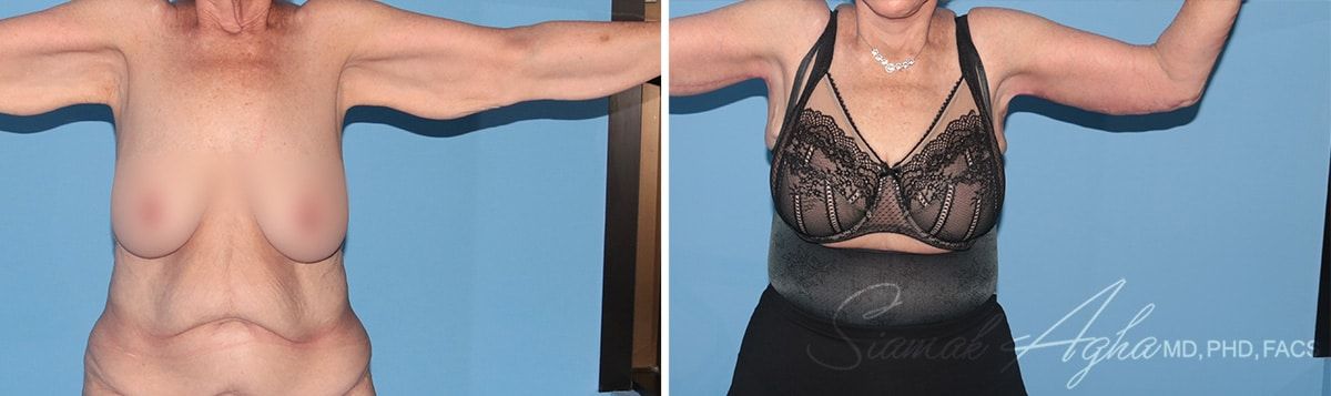 Arm Lift Before & After