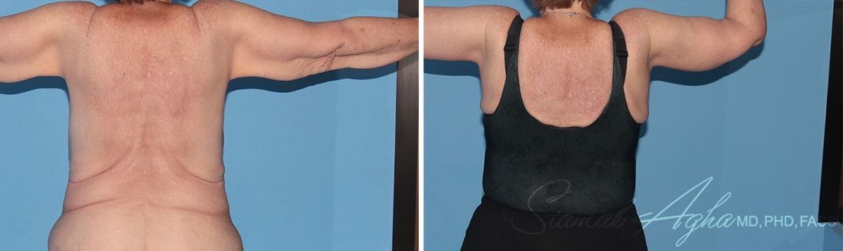 Arm Lift Before & After