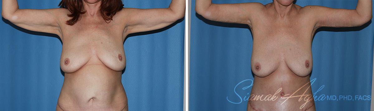 Arm Lift Before & After