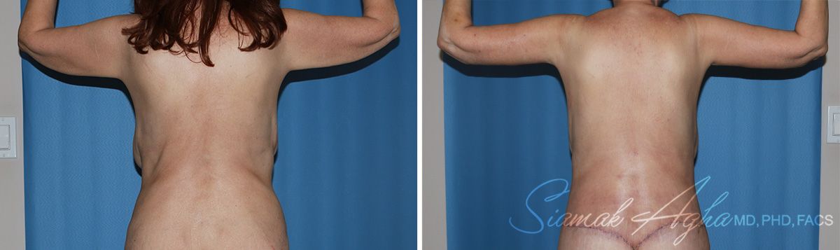 Arm Lift Before & After