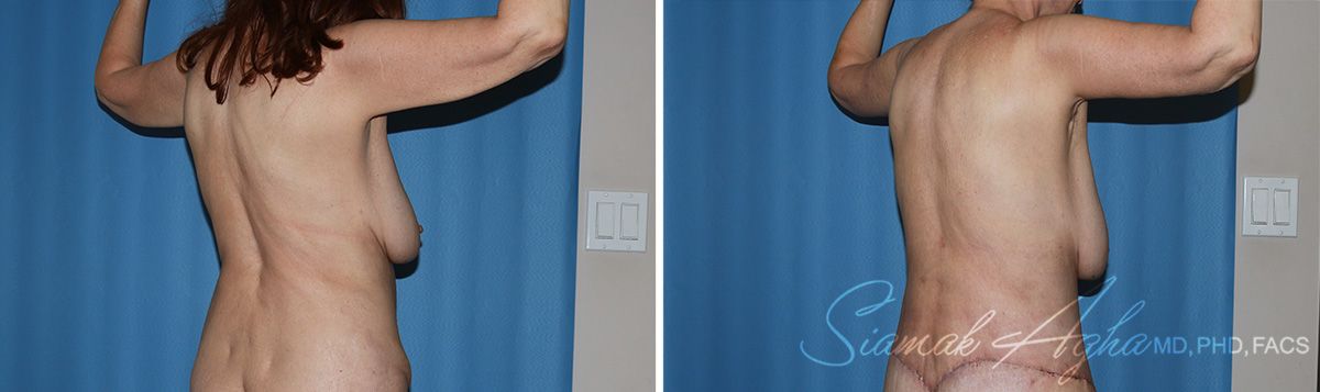 Arm Lift Before & After