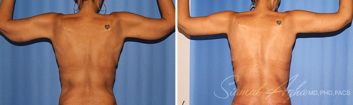 Arm Lift Before & After
