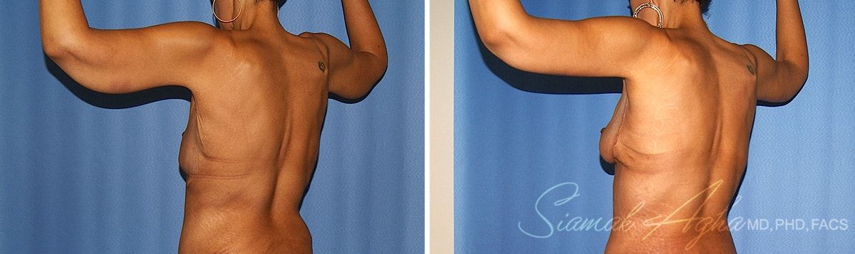 Arm Lift Before & After