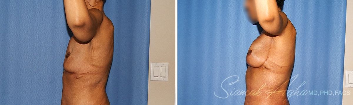 Arm Lift Before & After