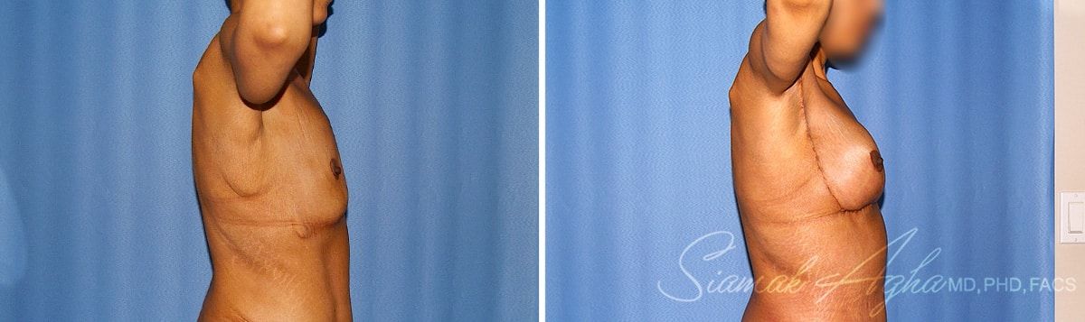 Arm Lift Before & After