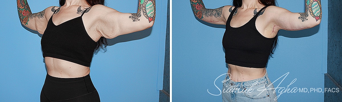 Arm Lift Before & After