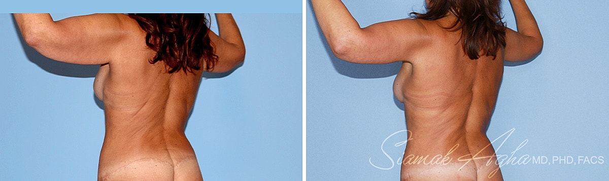 Arm Lift Before & After