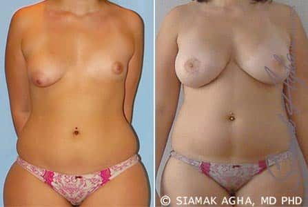 Breast Fat Transfer Before & After