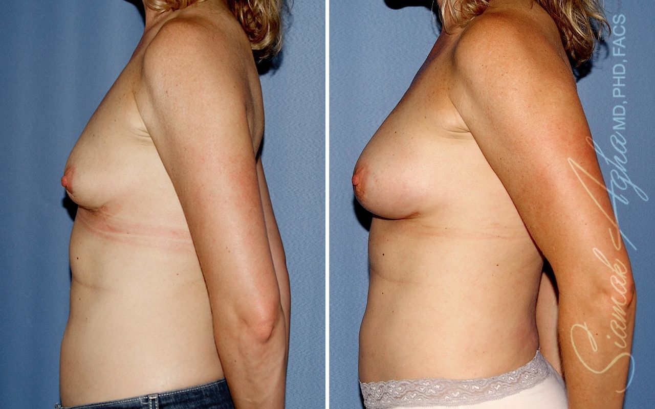 Breast Fat Transfer Before & After