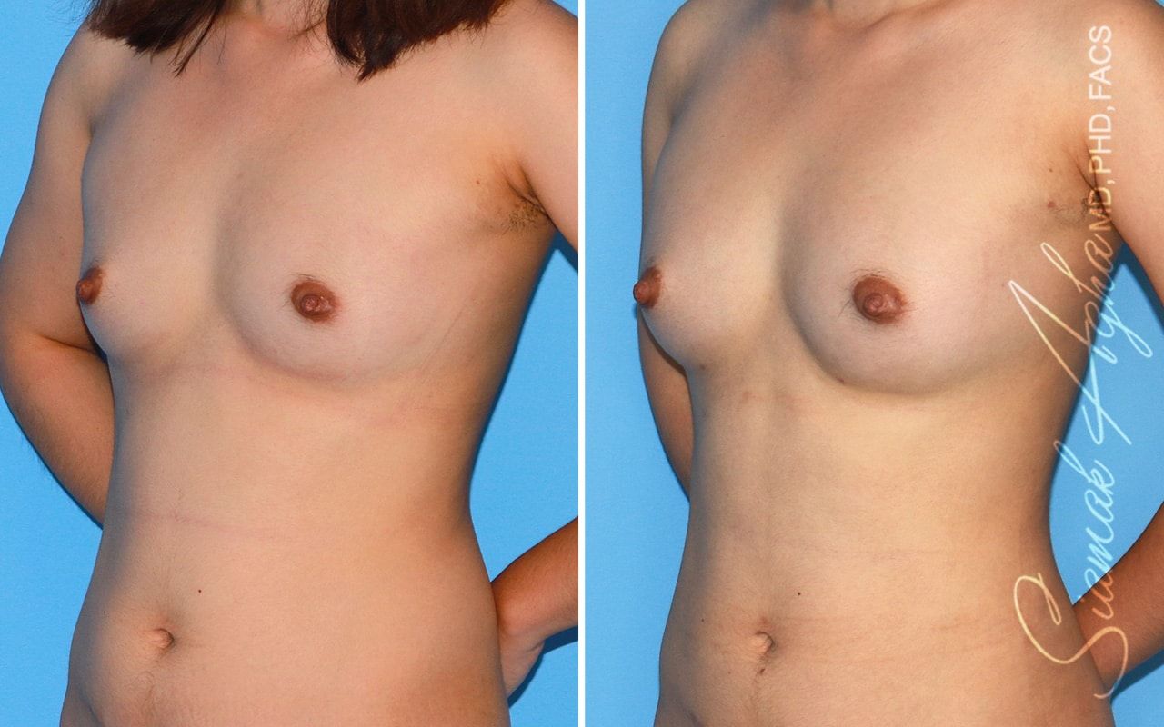 Breast Fat Transfer Before & After