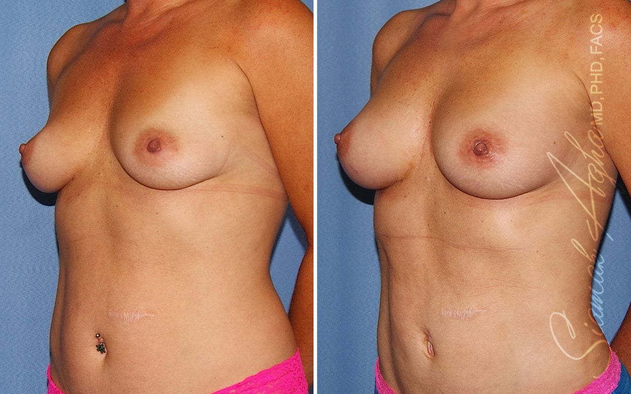 Breast Fat Transfer Before & After
